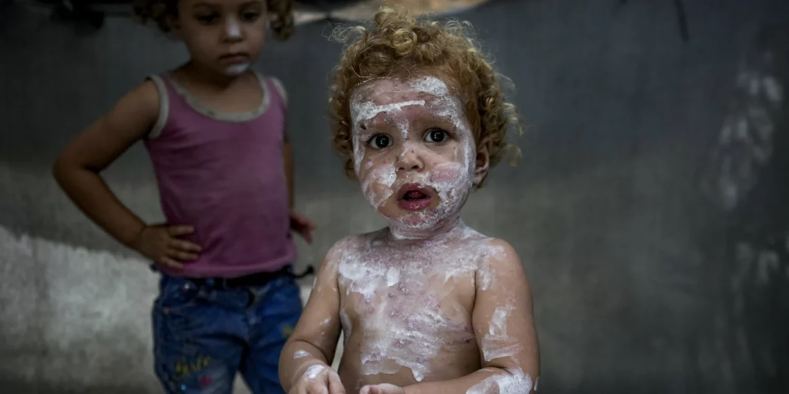 Palestinian children devastated by scabies, lice in Gaza tent camps