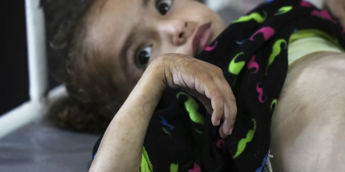 Gaza’s main hospital bursts at seams amid child malnutrition crisis