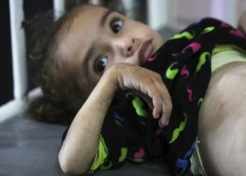 Gaza’s main hospital bursts at seams amid child malnutrition crisis